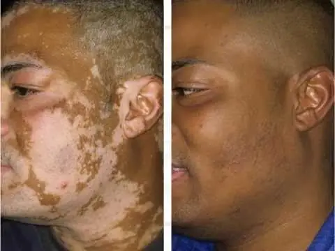 vitiligo