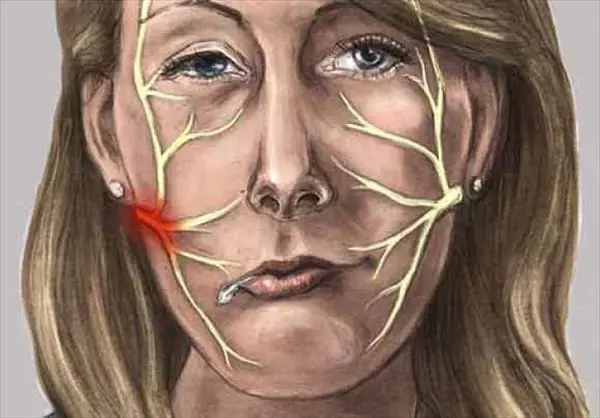 ¿Cómo prevenir una parálisis facial?