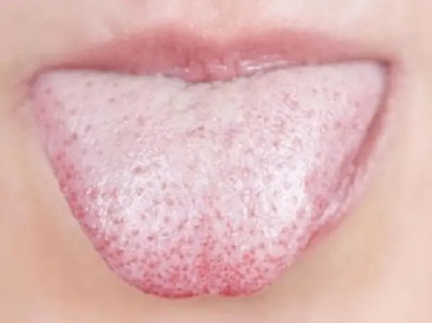 Detecta problemas de salud examinando tu lengua