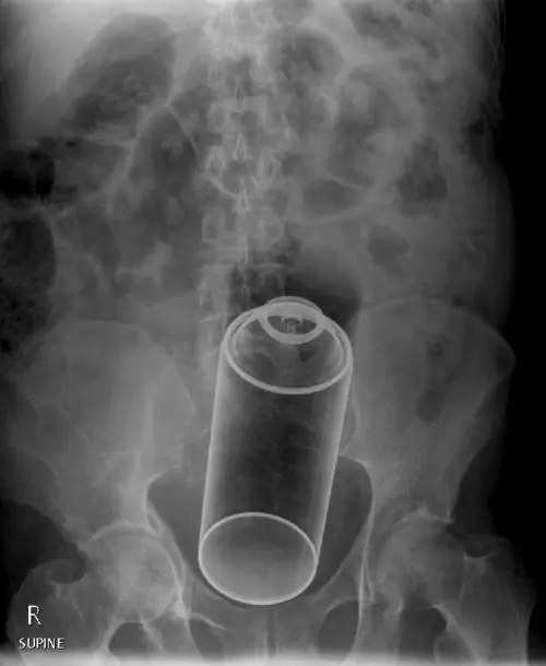 Radiografias del cuerpo humano y lo que encuentran