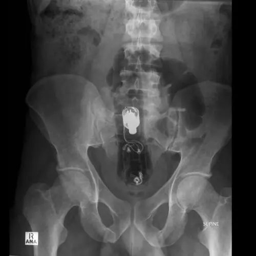 Radiografias del cuerpo humano y lo que encuentran