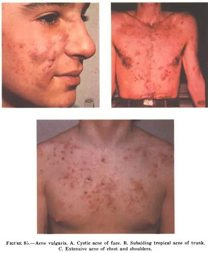 Secretos del acne.Por:All506