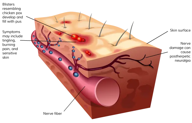 El riesgo de sufrir infarto o un ACV por el herpes Zoster