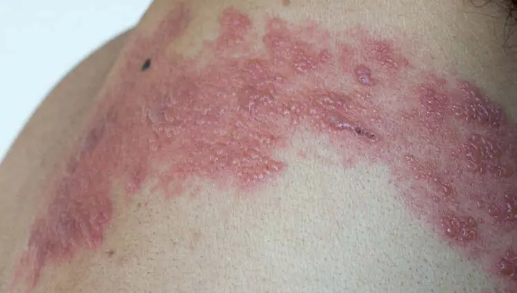 Herpes Zoster