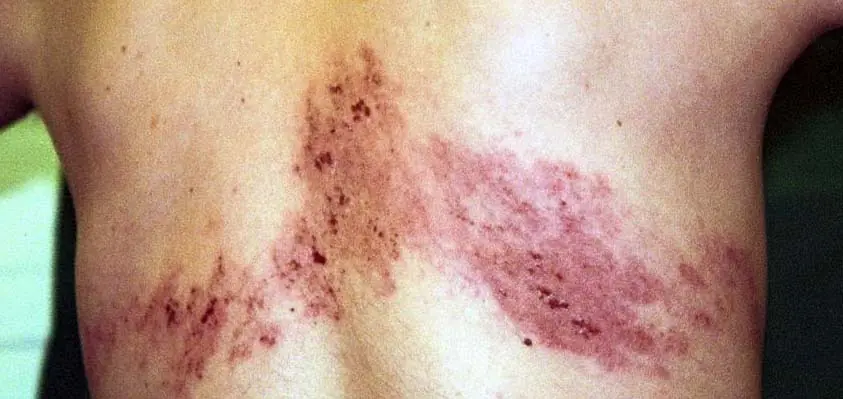 El riesgo de sufrir infarto o un ACV por el herpes Zoster