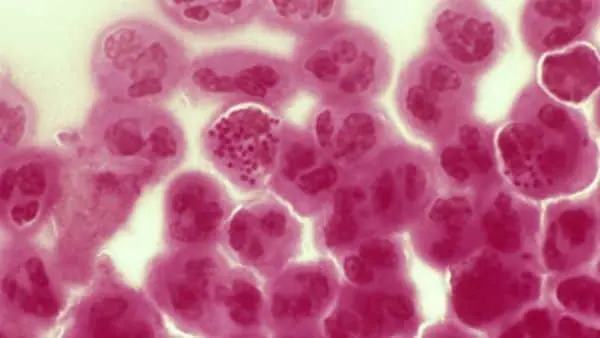 La OMS alerta acerca de nuevo tipo de gonorrea resistente