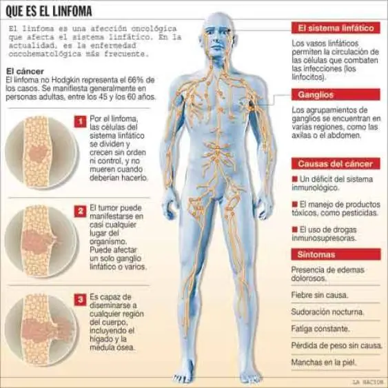 linfoma de Hodgkin (mi enfermedad)