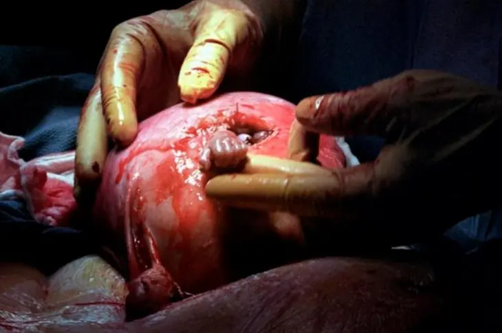 El feto que agarró la mano del cirujano ya es un joven de 16