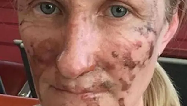 Así quedó lastimada mujer luego de comer un simple postre