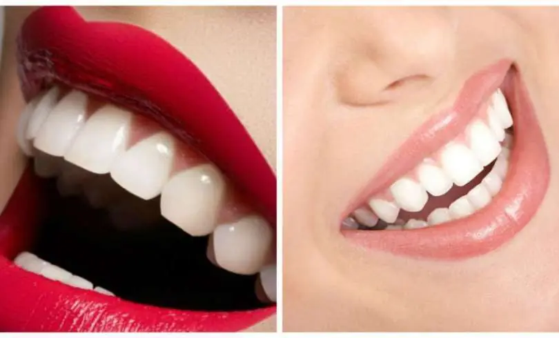 Conoce el método mas efectivo para blanquear tus dientes