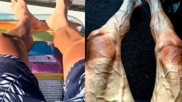 Así le quedaron las piernas después de andar en bicicleta
