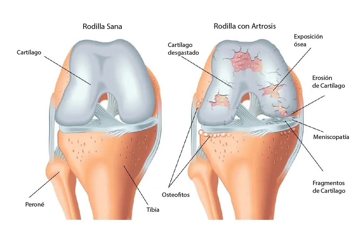 rodillas