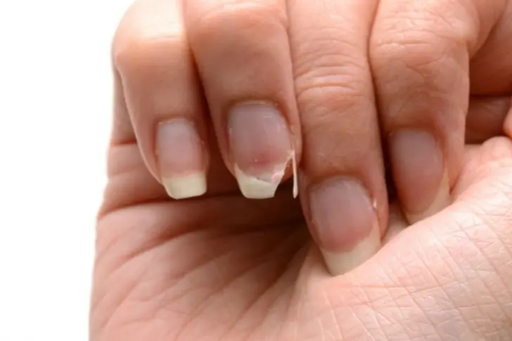 Remedios para las uñas rotas, ¡calma el dolor!