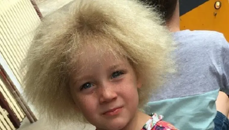 Niña padece síndrome que le impide peinarse