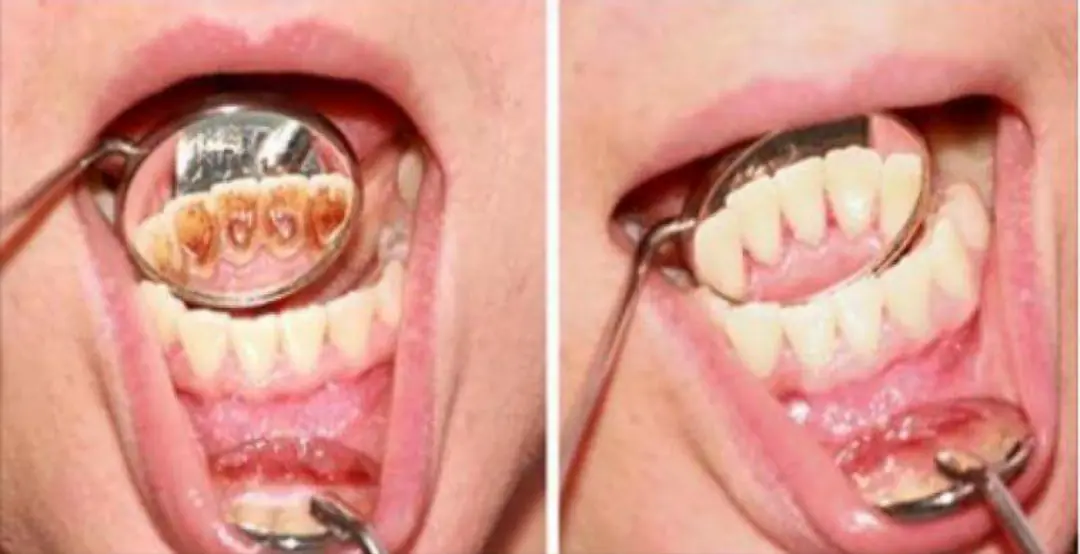 ¡Trucos caseros para quitar la placa dental muy fácil!