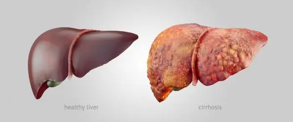 Cómo regenerar el hígado de forma natural