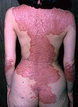 Cuando tu peor enemigo es tu  propio cuerpo.