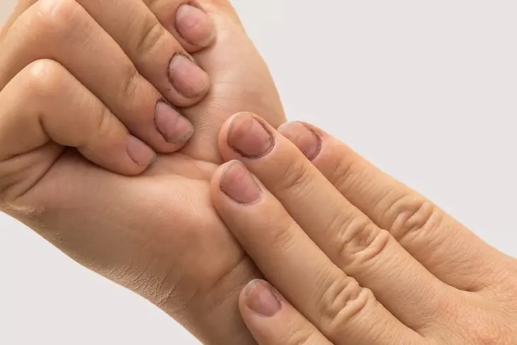 ¡Ojo! morderse las uñas es peor de lo que imaginas...