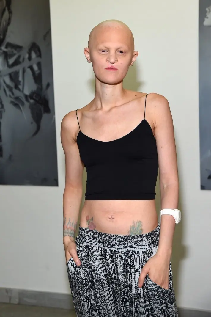 Conoce a Melanie Gaydos la modelo con raro desorden genética