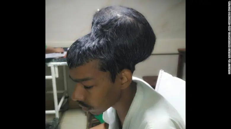 Tumor Cerebral