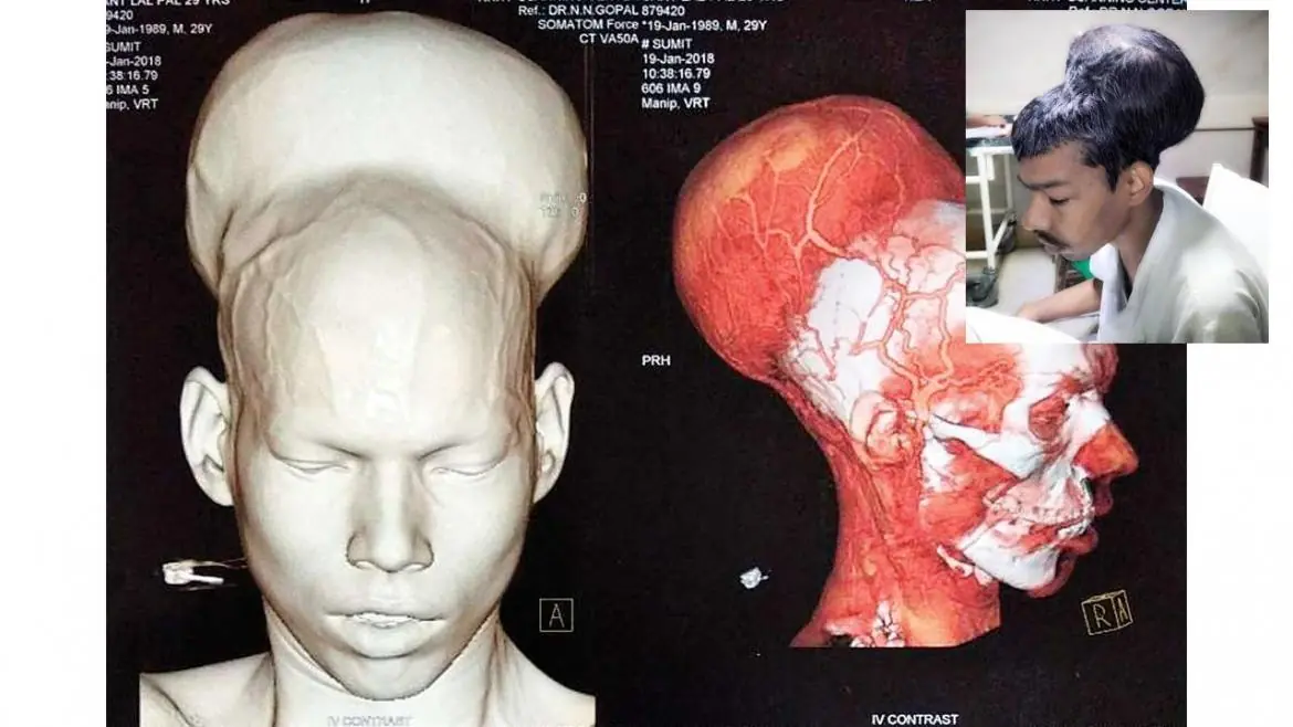 Cirujanos extraen un tumor cerebral de casi 2 kilos