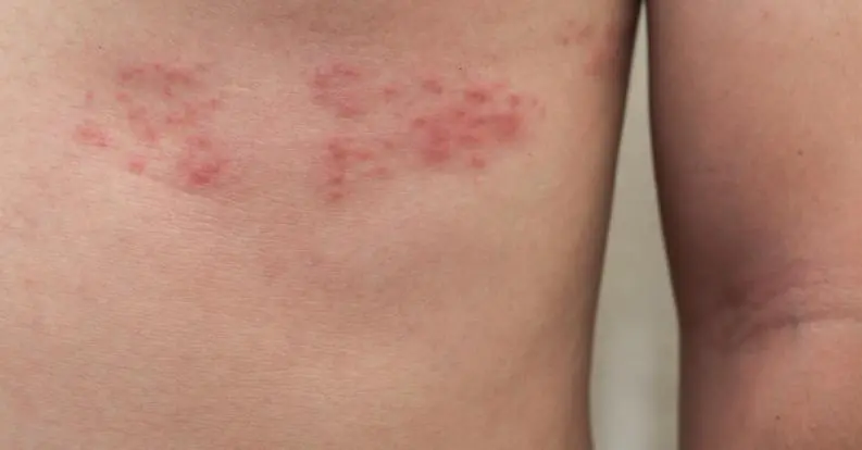 Culebrilla: una enfermedad común que se activa con el estrés