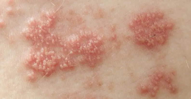 culebrilla