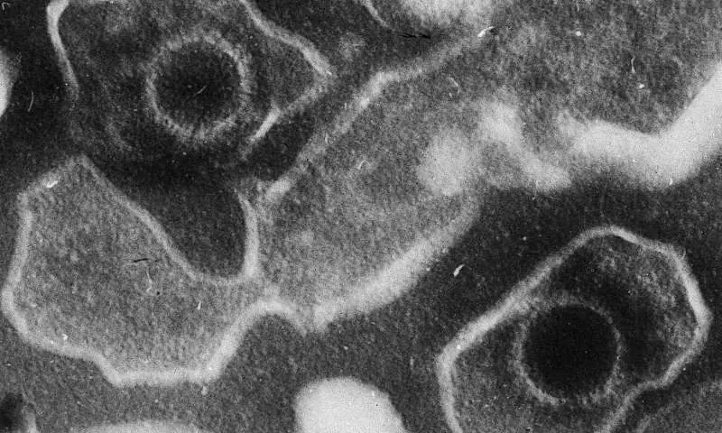 Virus de Epstein-Barr vinculado a siete enfermedades graves