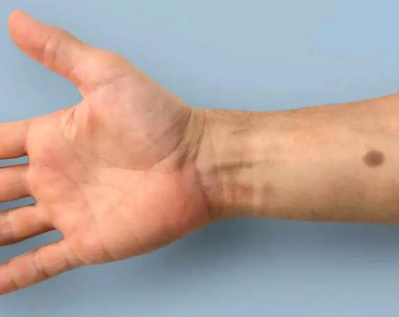 Crean “tatuajes” para la detección del cáncer