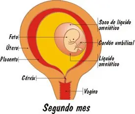 aborto