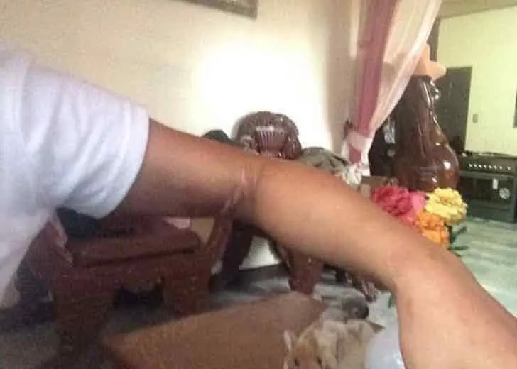 Pensó que era una picadura; tiempo después perdió el brazo