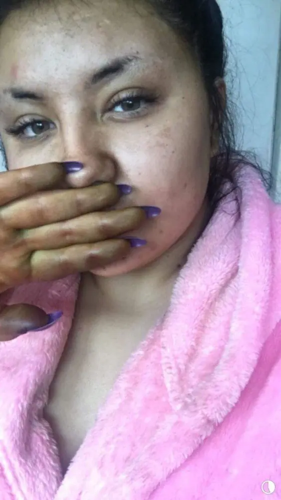 Se pone bronceador en la piel y acaba como Fiona de “Shrek”