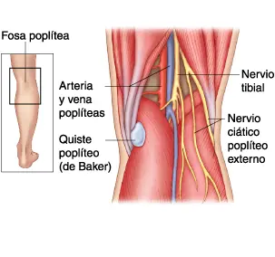 quiste
