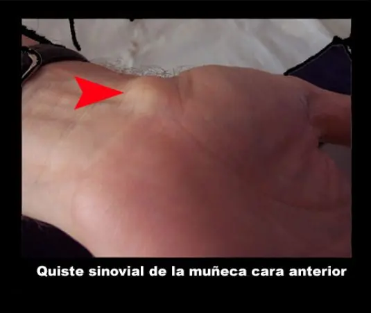 tumor