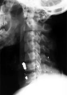cervicalgia