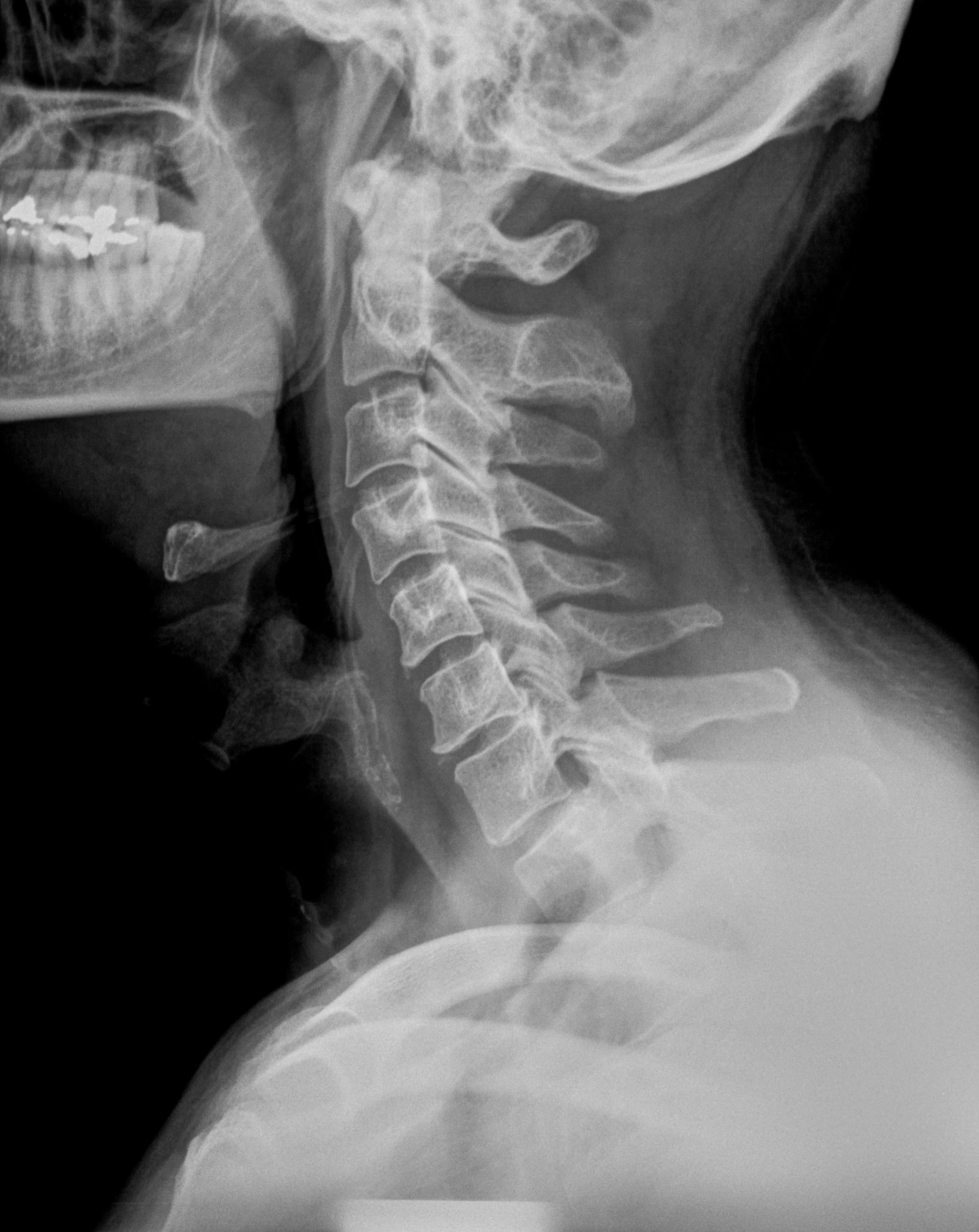 Dolor Cervical