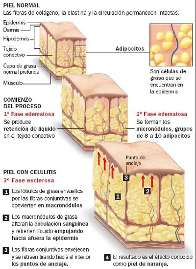 Como Eliminar La Celulitis - Causas y Soluciones