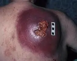 cura para el cancer de piel