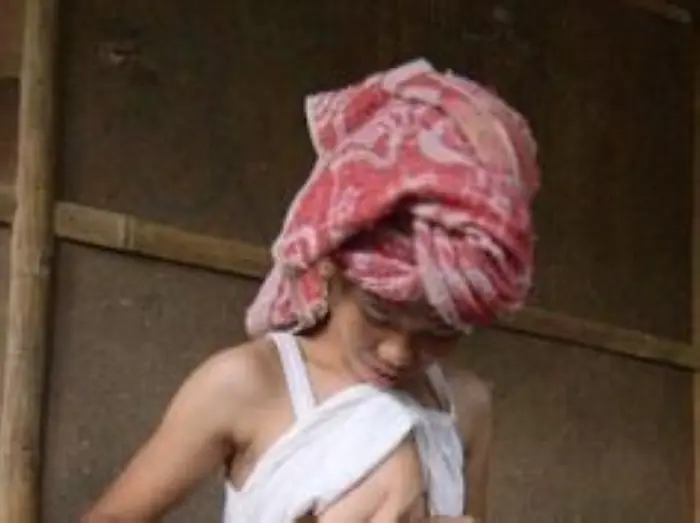 Le removerán “gemela parásita ” que carga en el pecho…